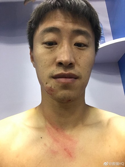 毅腾球员郝强赛后晒伤口